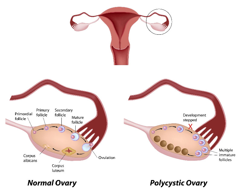 Polycystic Ovary Sex 15