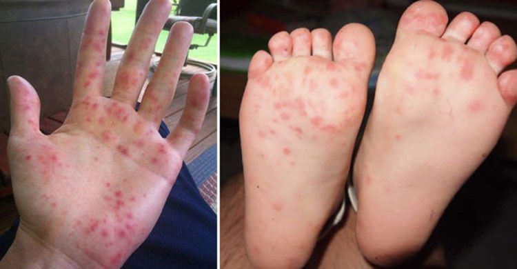 Natural Remedies For Hand Foot And Mouth Virus In Children Natural Remedies For Hand Foot And Mouth Virus In Children