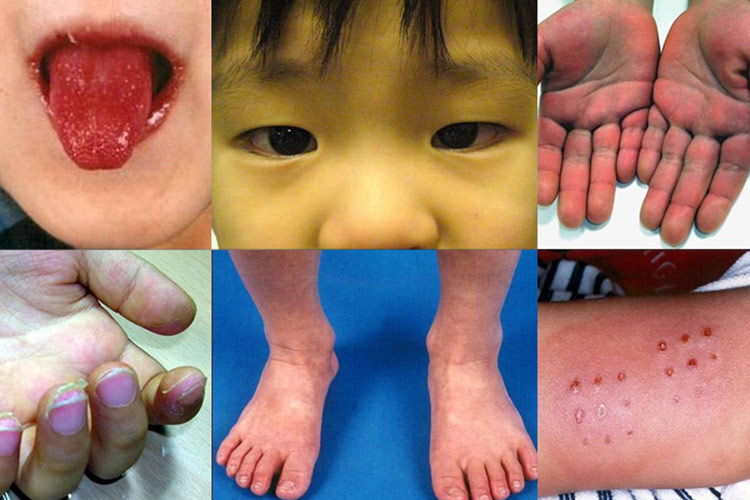 Kawasaki Disease Symptoms, Causes and Treatment Best Herbal Health