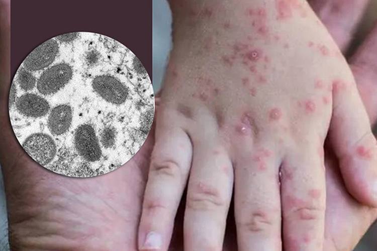 What is monkeypox symptoms causes diagnosis and treatment